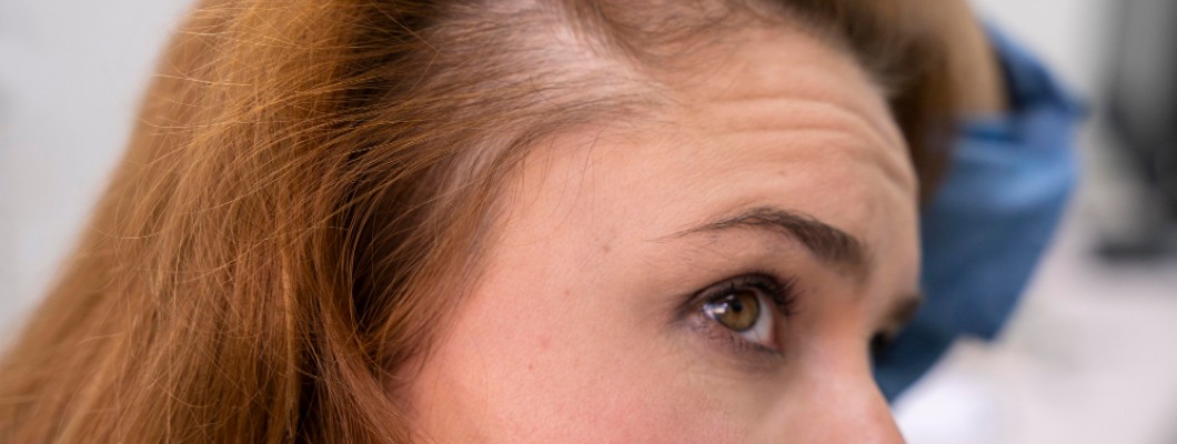 Alopecia e perdita di capelli: i nanopeptidi bioregolatori come soluzione scientifica