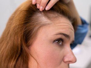 Alopecia e perdita di capelli: i nanopeptidi bioregolatori come soluzione scientifica